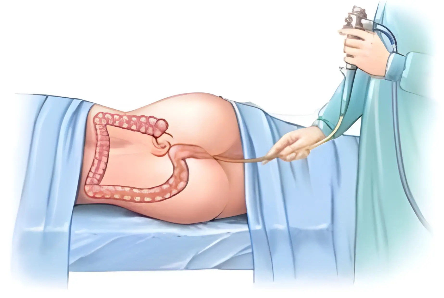Ayurvedic Herbal Enema (Basti) therapy administered by an Ayurvedic practitioner for detoxification and digestive wellness